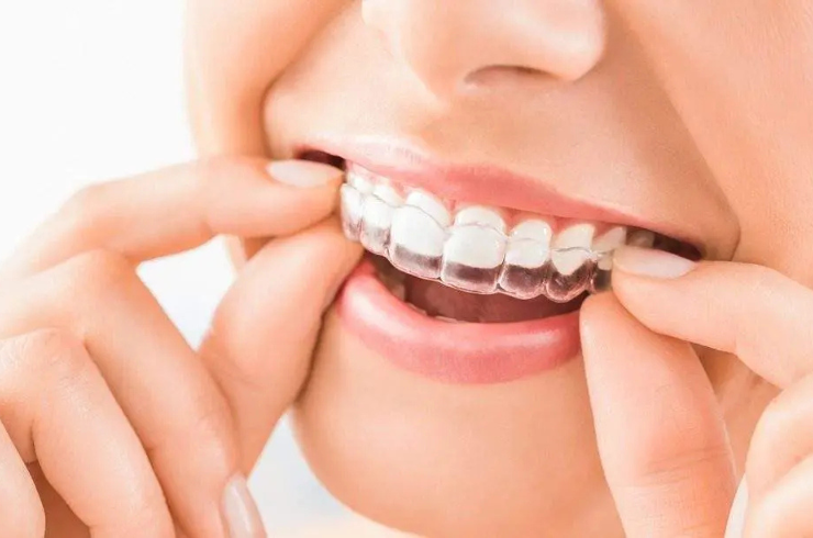 Invisible Aligners