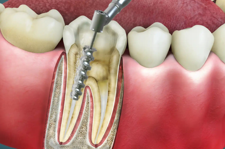 Root Canal Treatment