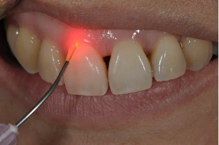 Laser Dentistry